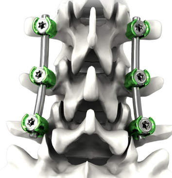 胸腰椎后路釘棒內(nèi)固定系統(tǒng)大博