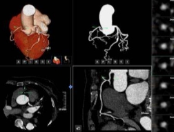 冠脈功能影像分析系統(tǒng)qfr-a