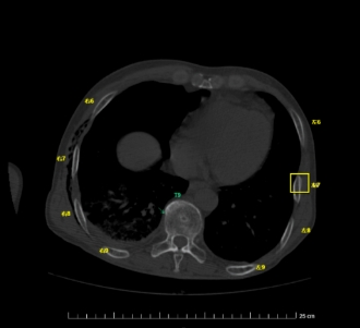 胸部ct圖像處理軟件pneumoniago